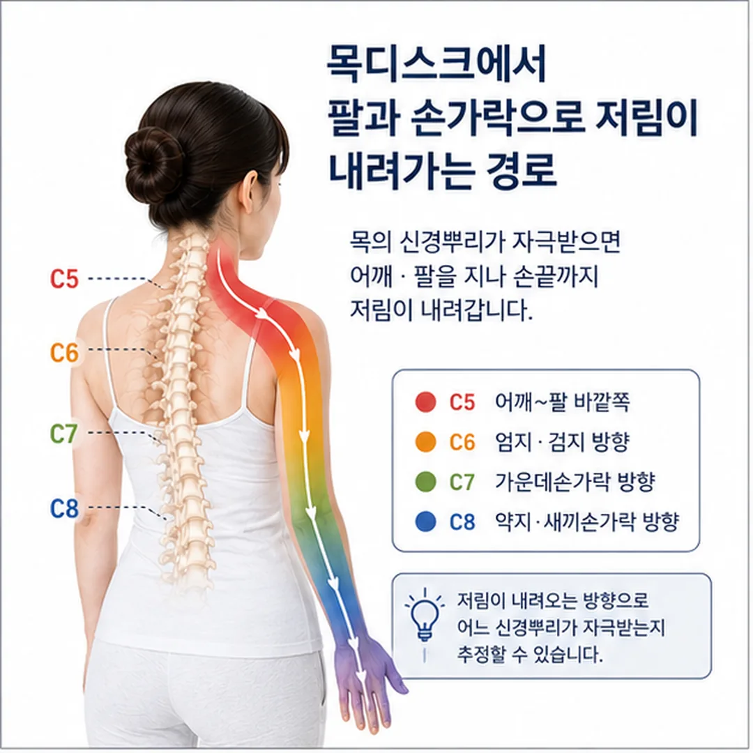 목디스크에서 팔과 손가락으로 저림이 내려가는 경로