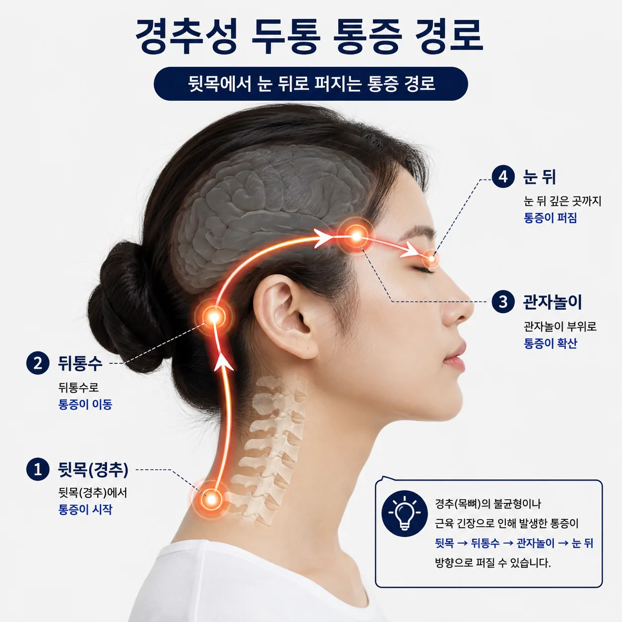 경추성 두통이 뒷목에서 눈 뒤로 퍼지는 방향을 보여주는 도해
