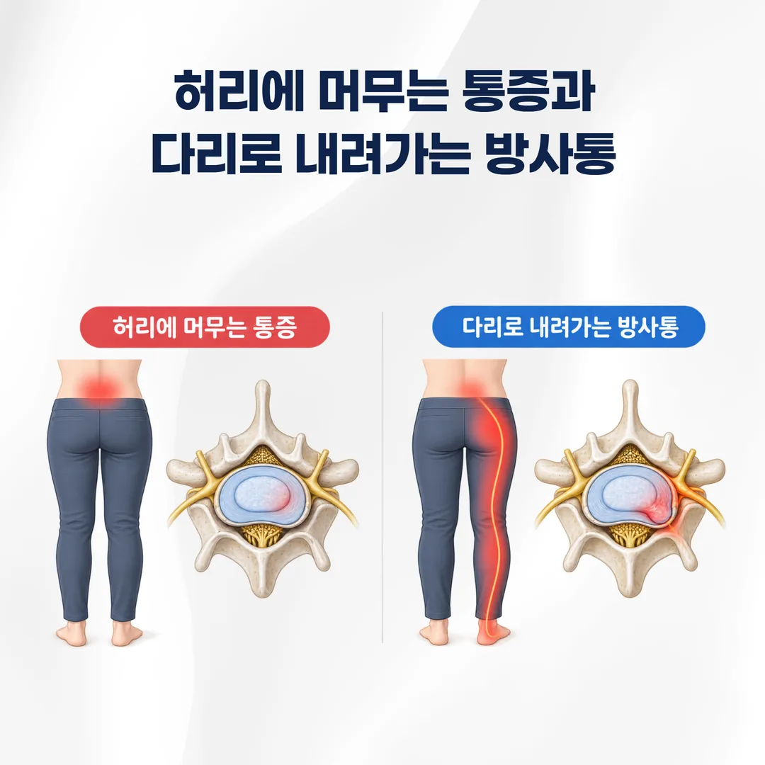 허리에 머무는 통증과 다리로 내려가는 방사통의 차이를 나타낸 개념도
