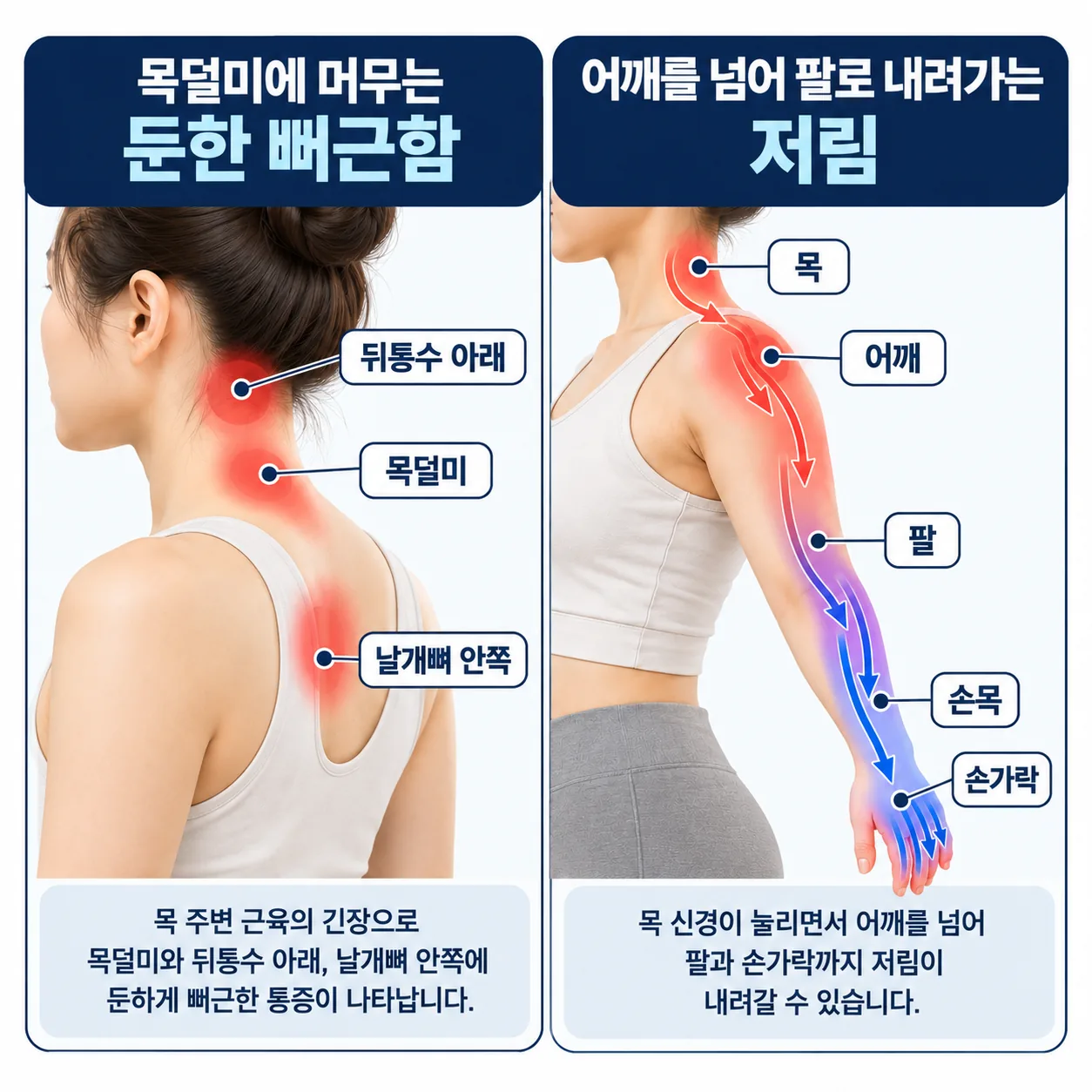목덜미에 머무는 뻐근함과 팔로 내려가는 저림을 나눠 보여 주는 아침 목 통증 비교 그림